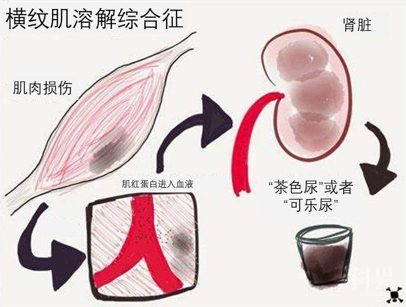 血液生化指标检查, 结果显示: 她患上了"横纹肌溶解综合征"