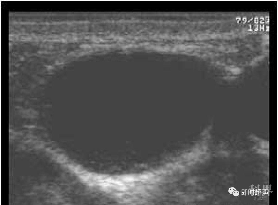 【交流】鳃裂囊肿超声诊断