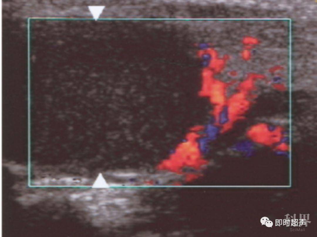 【交流】鳃裂囊肿超声诊断