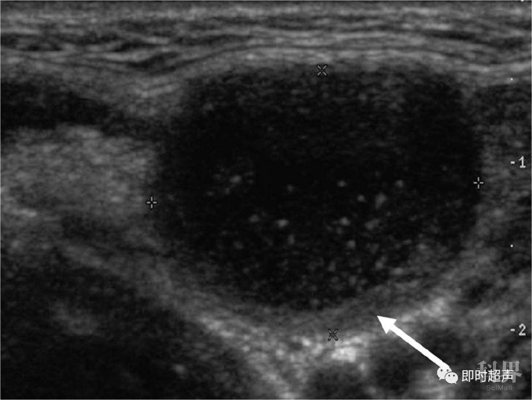 【交流】鳃裂囊肿超声诊断