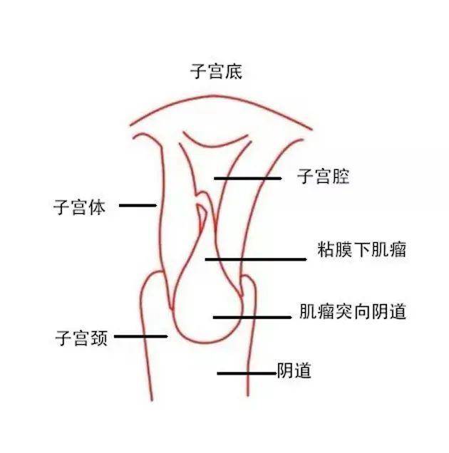 郭述真:五花八门的子宫肌瘤之粘膜下子宫肌瘤