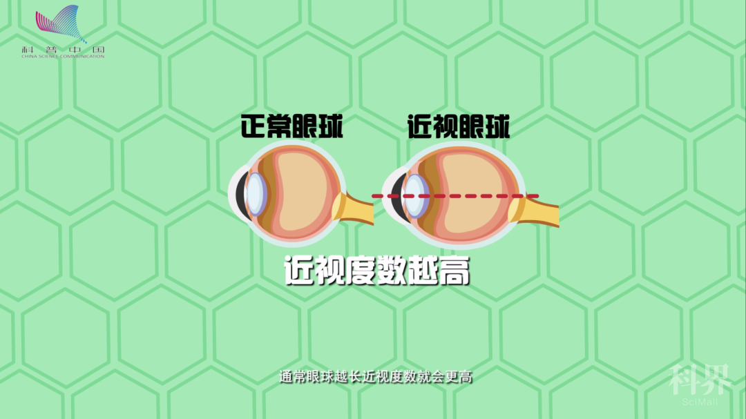 近视眼戴眼镜度数涨得快?眼科医生说.