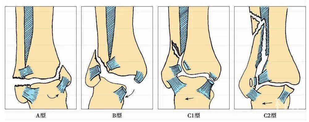 踝关节骨折的常见分型