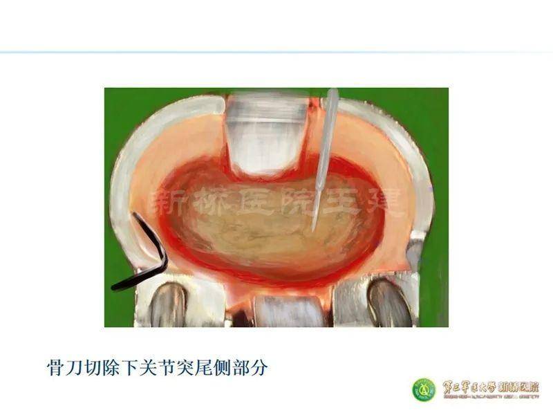 mis-tlif手术关键技术之心得手绘