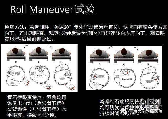 【科普】耳朵里会引起的眩晕的耳石症