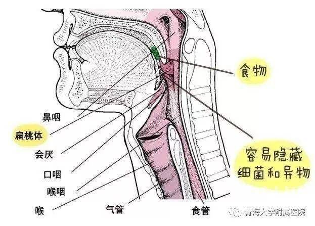 急性滤泡性扁桃体炎 炎症侵及扁桃体实质内的淋巴滤泡,引起充血,肿胀