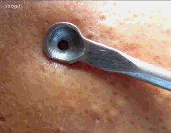 痘痘,鼻头挤出的