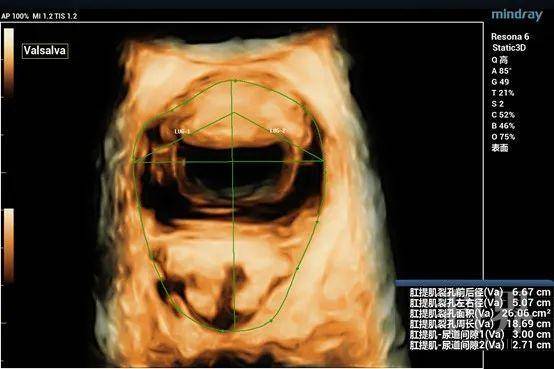 三维超声测量肛提肌裂孔面积