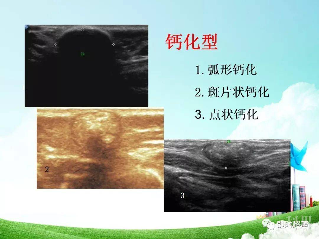 【探讨】钙化上皮瘤(毛母质瘤)超声诊断