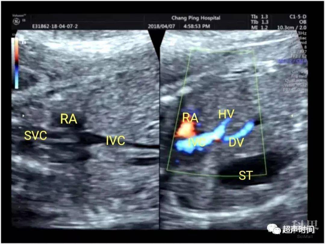 【病例】超声典型病例:胎儿法洛四联症合并右位主动脉