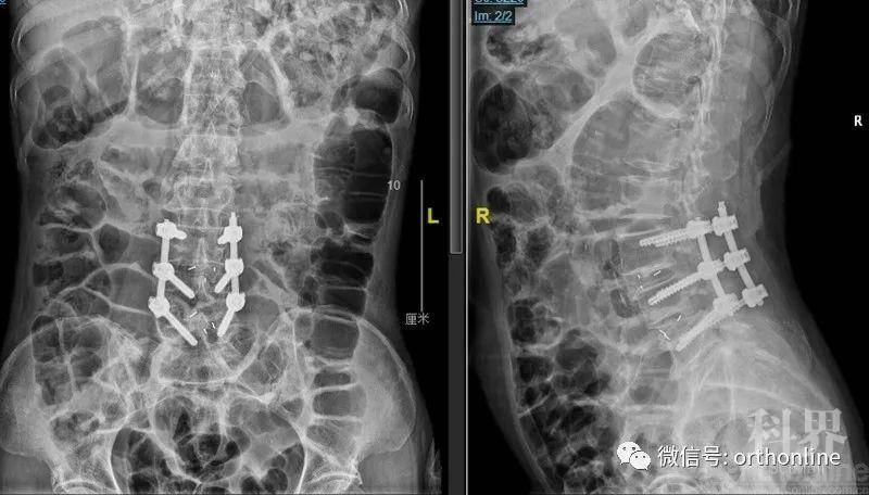 手术近段减压交界区腰3下椎板术后麻醉清醒后出现急性腰椎管狭窄症状