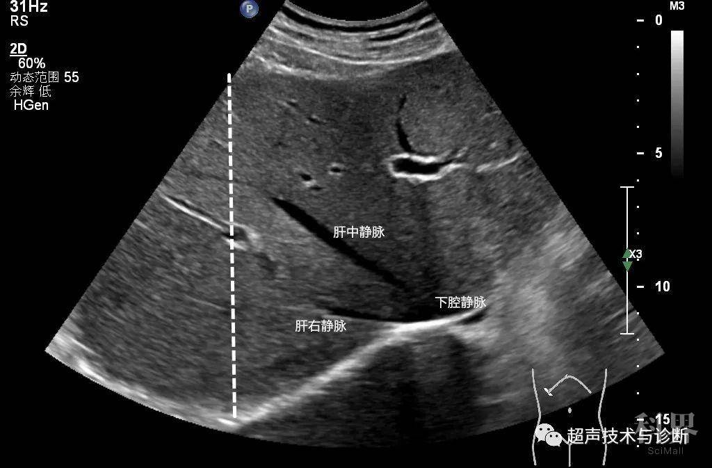 参考值 成年人:11-14cm 二,肝左叶上下径及前后径 ★扫查方法 探头