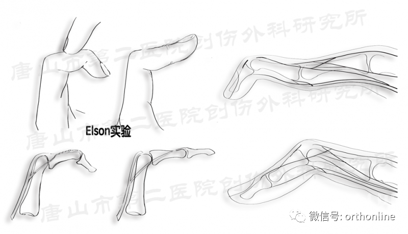 阅"图"理解 | 一文掌握手部肌腱的修复