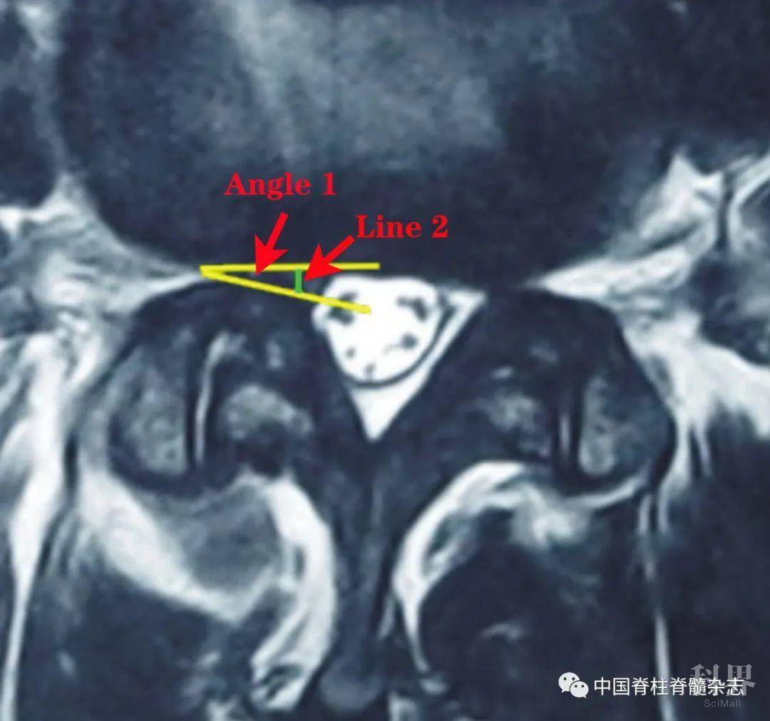 全内镜下可视化经椎弓根上切迹入路手术治疗腰椎侧隐窝狭窄症的疗效