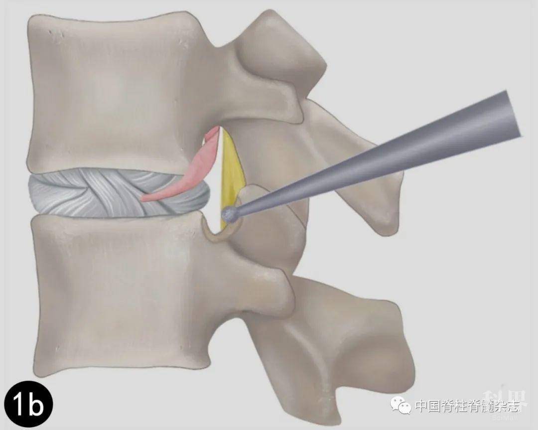 全内镜下可视化经椎弓根上切迹入路手术治疗腰椎侧隐窝狭窄症的疗效