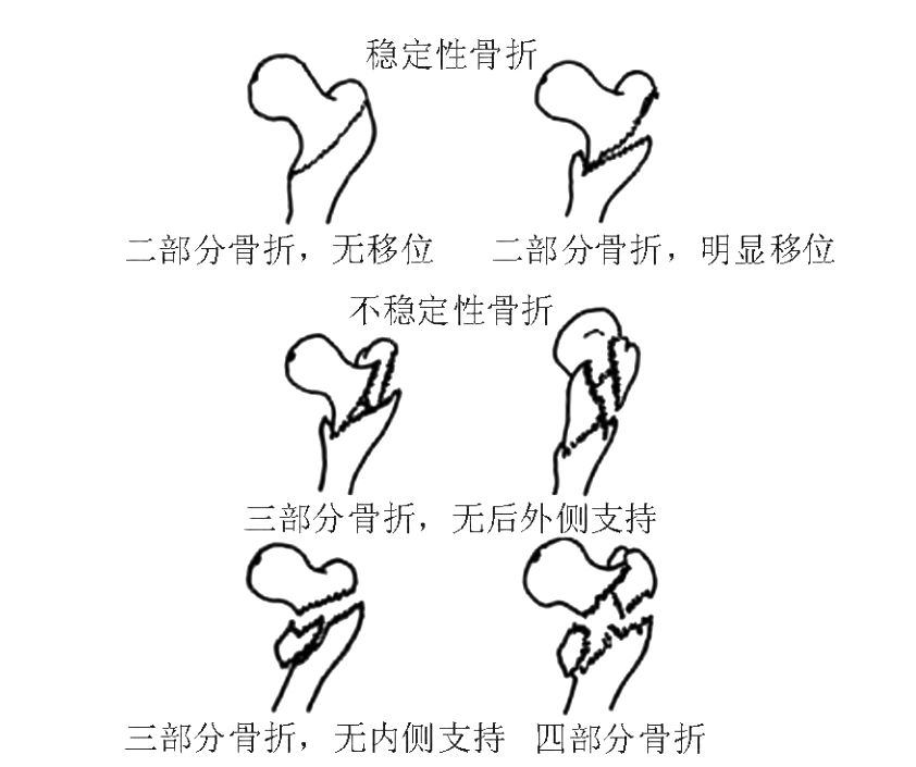 jensen分型其中Ⅰ型1度和Ⅰ型2度为稳定性骨折,术后骨折无畸形,愈合率