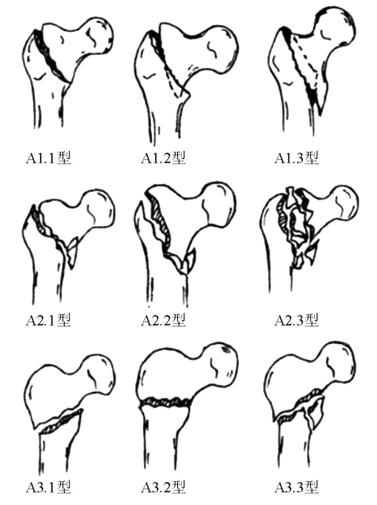 收藏股骨转子间骨折常见分型