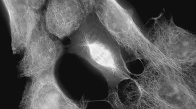 2、偏光显微镜下的转移性肝癌细胞.jpg