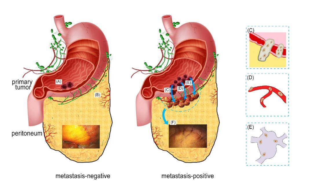 自动化所研发影像组学新技术实现胃癌隐匿性腹膜转移智能诊断的新突破
