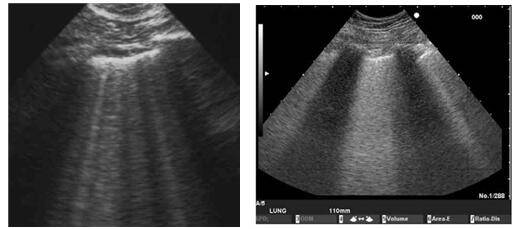 新型冠状病毒肺炎肺部超声检查方案
