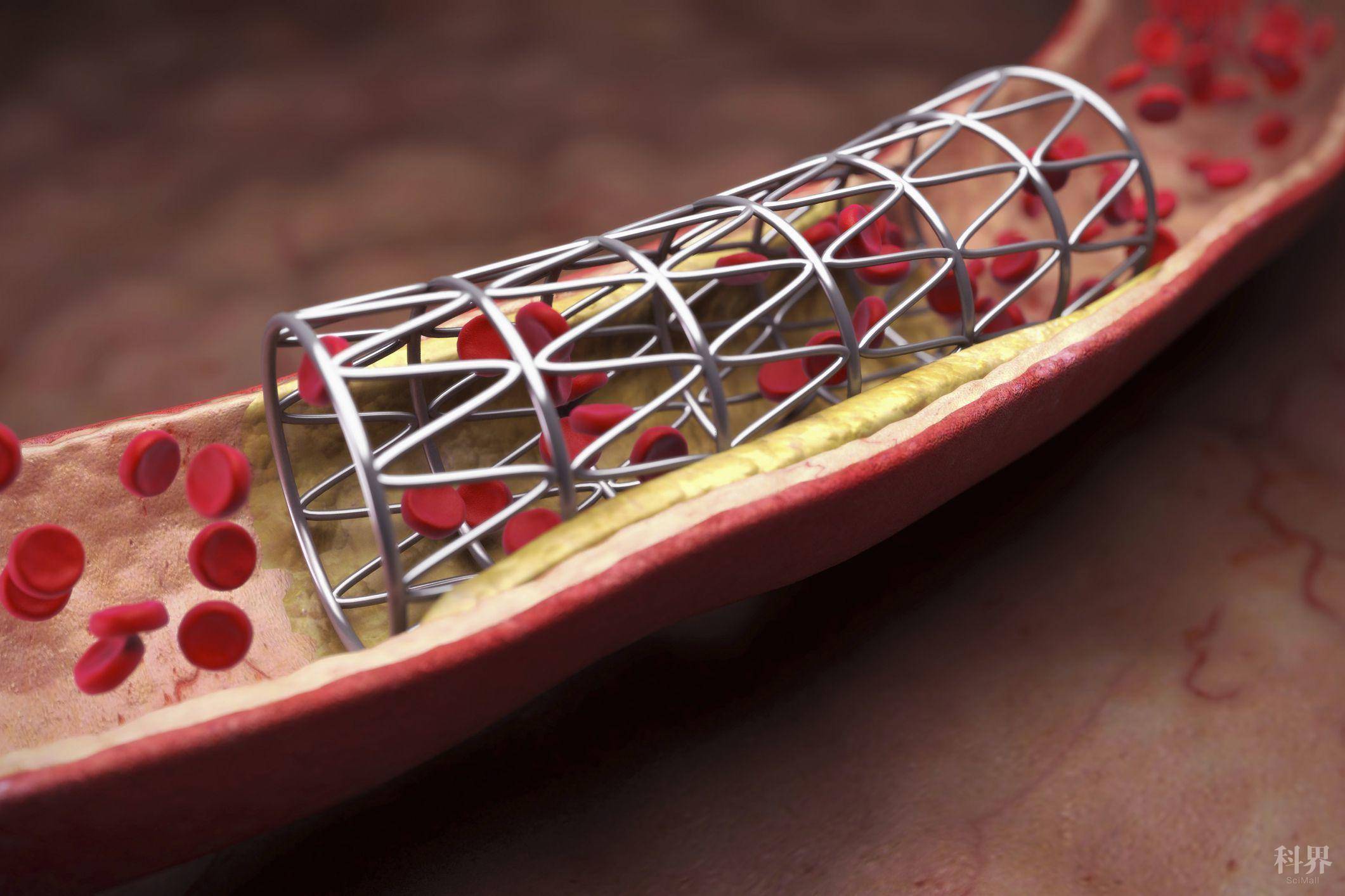 "地板价"心脏支架平稳着陆,只是开始