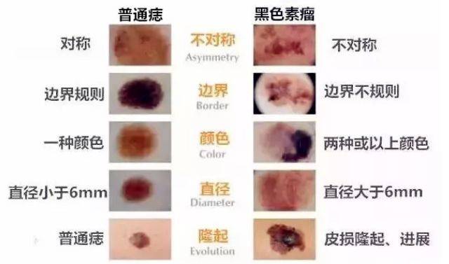 你身上有几个黑痣它们会不会变成黑色素瘤