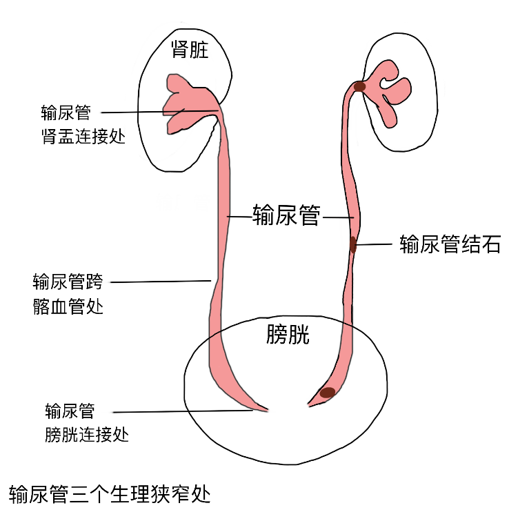 女性输尿管走形图片