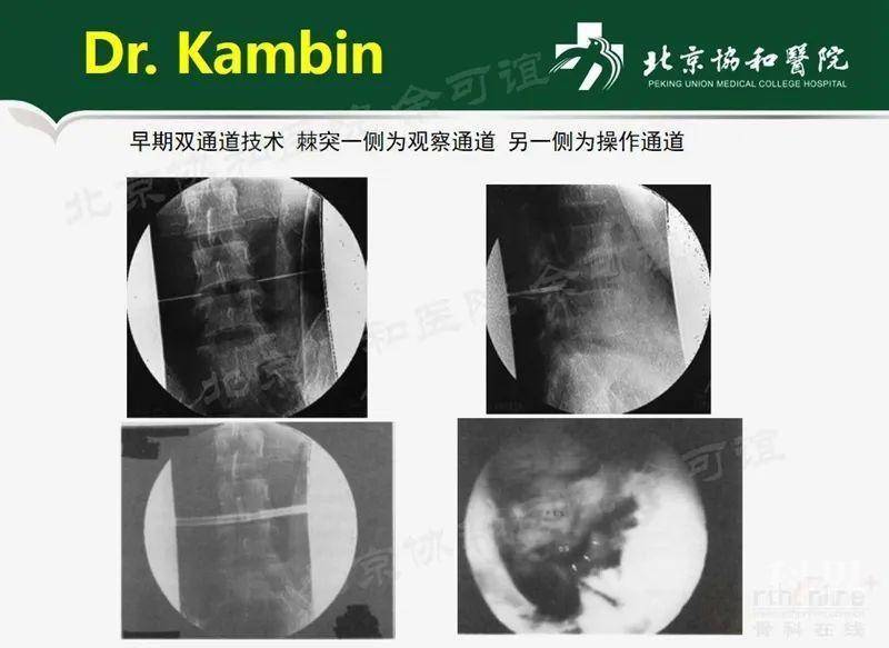一文读懂双通道脊柱内镜的前世今生学术资讯 科技工作者之家