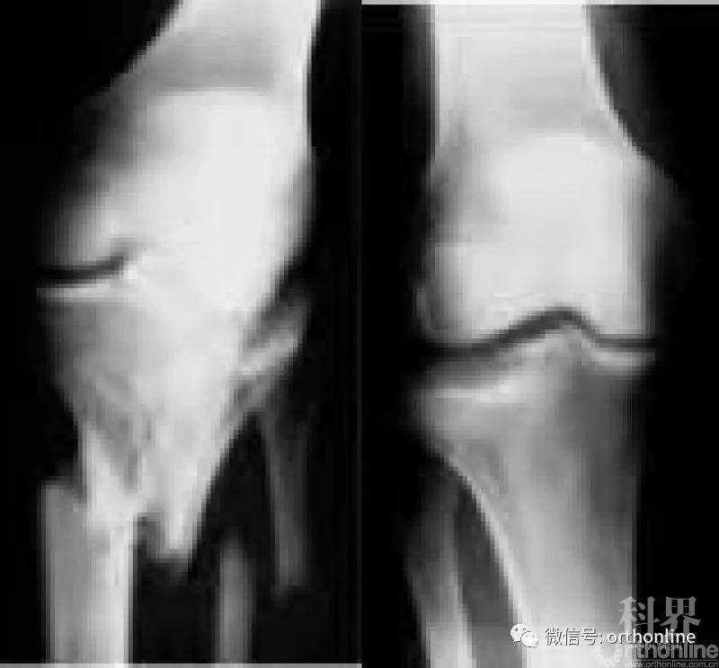 一文掌握胫骨平台骨折临床诊疗要点学术资讯 科界