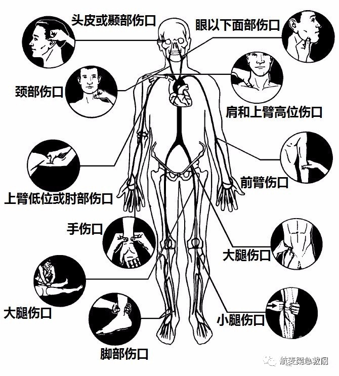 传统的指压止血方法需要熟悉解剖不好赘述0303--止血带止血法这是在