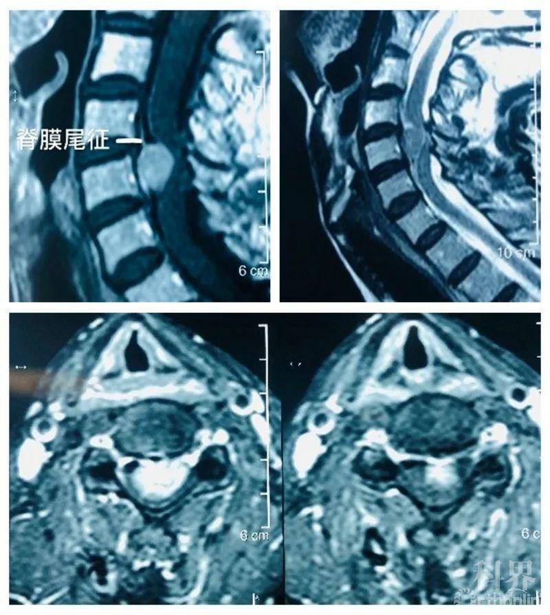 脊膜瘤晚期图片
