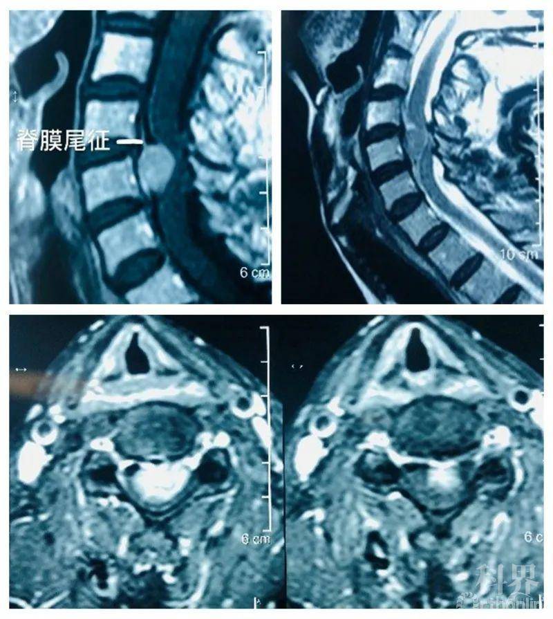 硬脊膜瘤图片