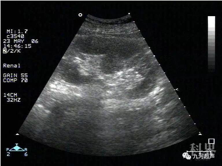 交流9種腎臟先天發育異常的超聲診斷