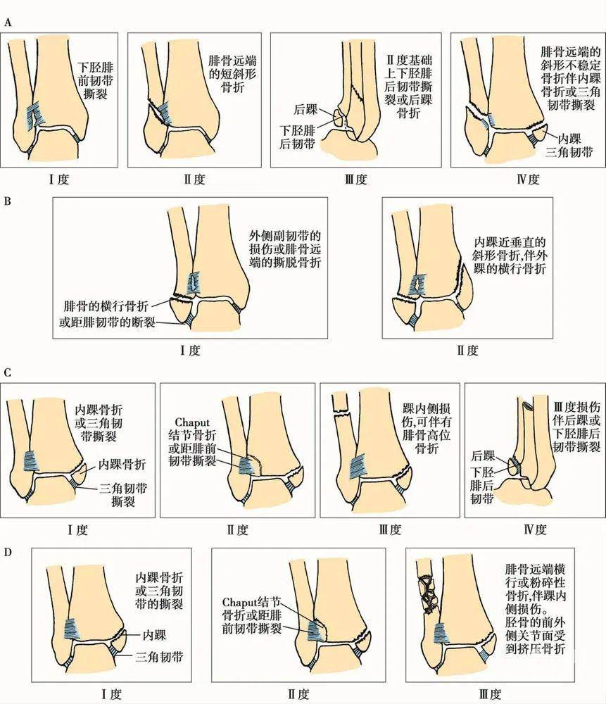 收藏| 踝关节骨折的常见分型