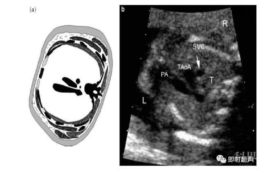心脏三血管切面详解三血管-气管切面的观察内容 从左到右依次是肺动脉