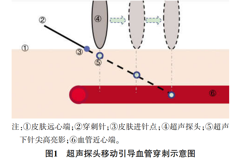 学术速递手臂输液港置管你试过用超声探头移动引导血管穿刺吗