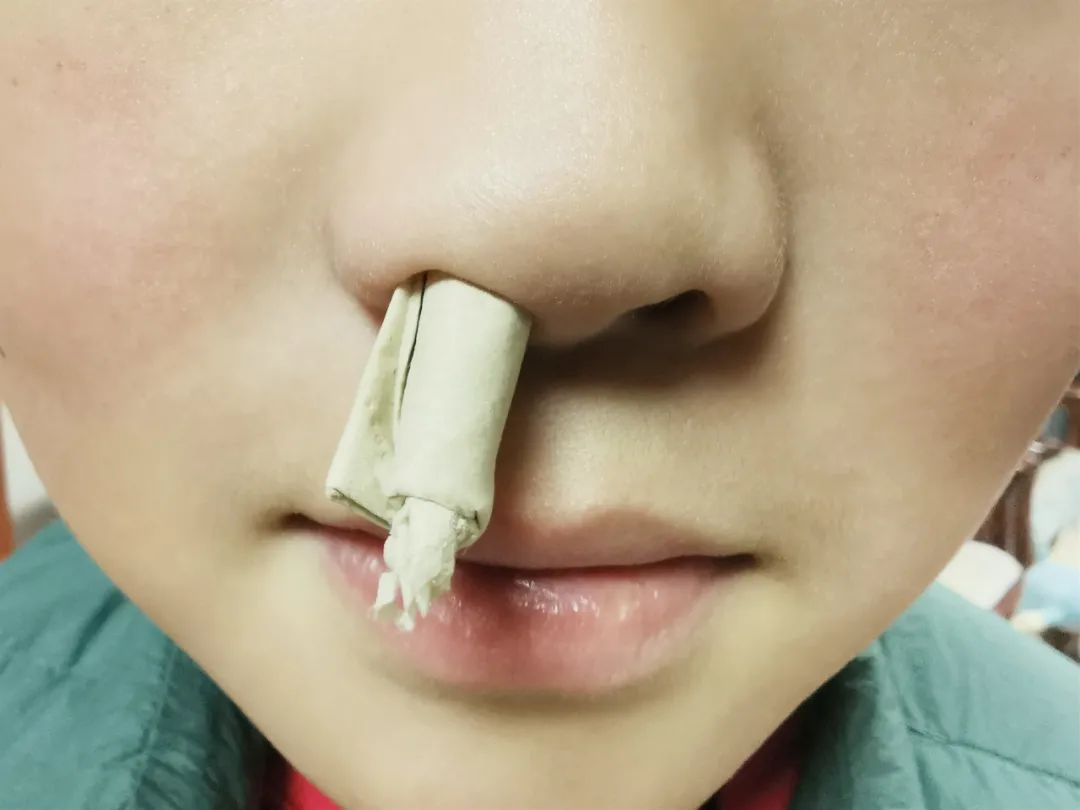 【技术】国药同煤总医院：耳鼻喉少有罕见的“探囊”取异物！|患者|异物|耳鼻喉科|取出|鼻腔|-健康界