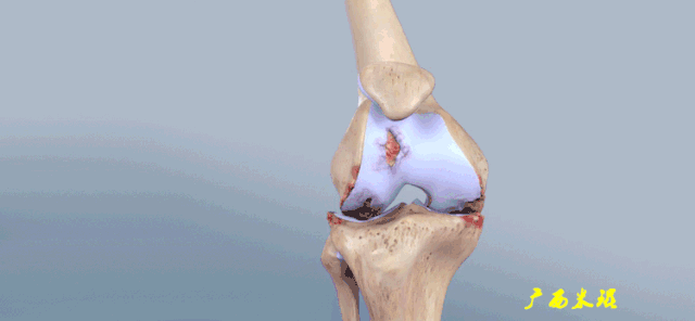 一文详解膝关节骨性关节炎的治疗学术资讯 科界